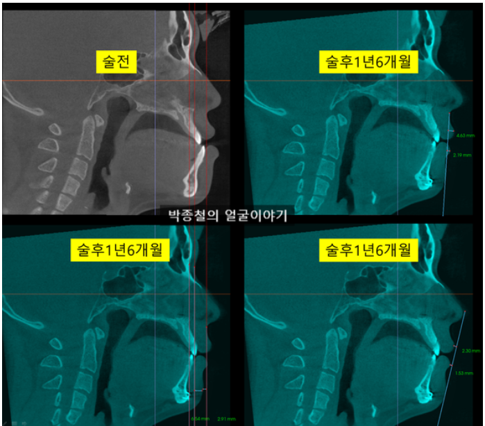 심미적 입술라인과 술후 1년6개월 단면이미지