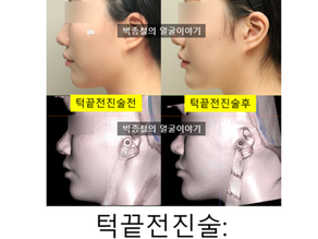 턱끝전진술 실패 방지, '비대칭'과 '뼈 계단 현상' 해결이 관건입니다