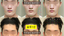 남자 주걱턱 양악수술 후기: 양악윤곽 1년, CT로 보는 정밀 분석