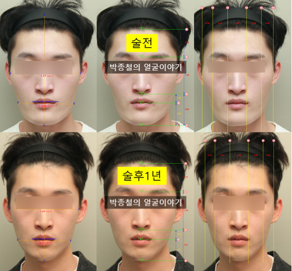 남자 주걱턱 양악윤곽 1년 얼굴비율 분석