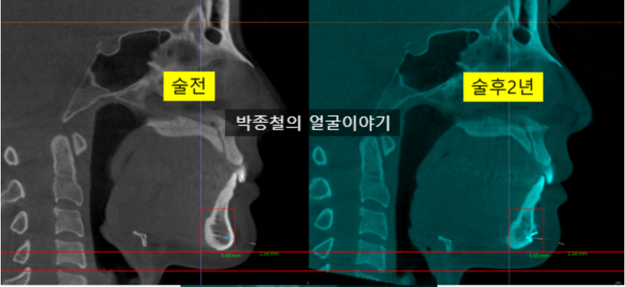 이미지 설명: 수술 전후의 CT 단면 비교 사진입니다. 턱끝뼈가 성공적으로 후방 이동하였으며, 그에 따른 턱밑 연조직의 매달림이나 처짐 현상은 관찰되지 않았습니다.