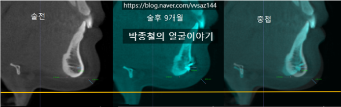 턱끝 후퇴술 (턱끝 후진술) 이중턱 발생여부