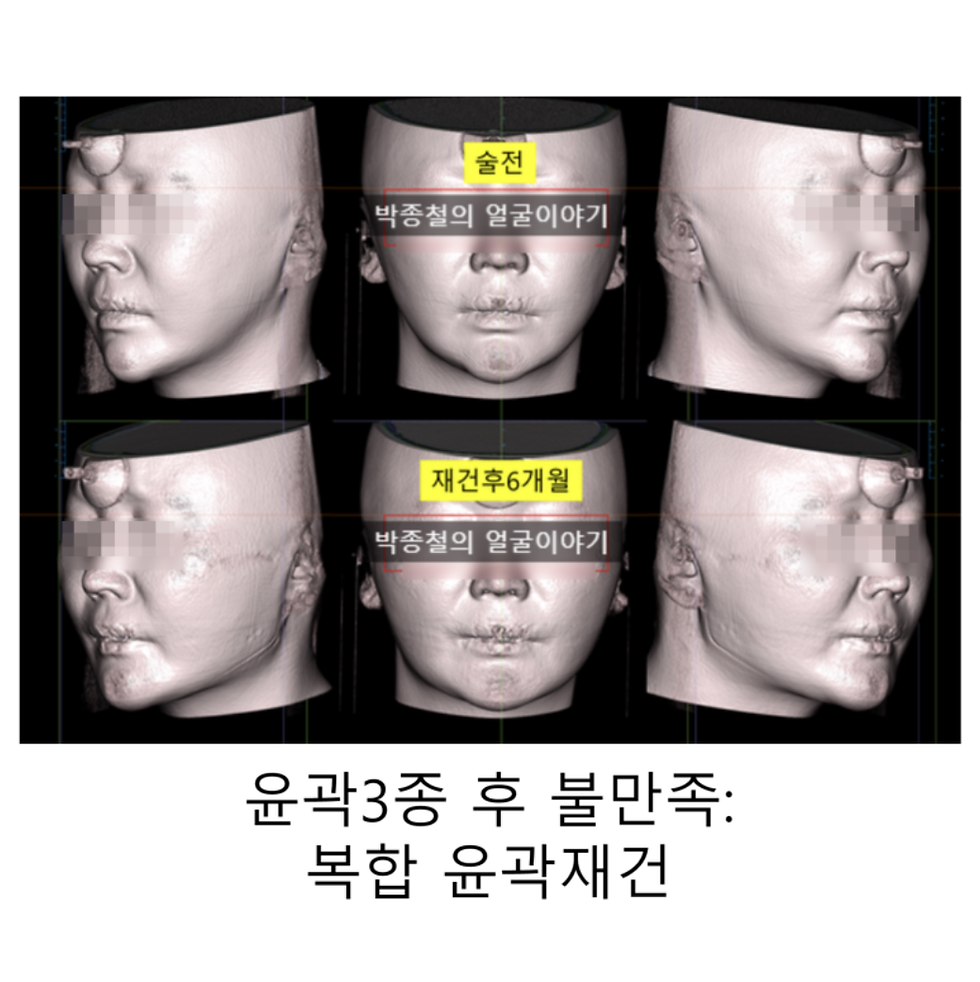 사각턱재건·턱끝재건 복합 윤곽재건