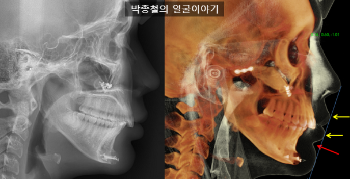 수평피개교합이 과도한 경우