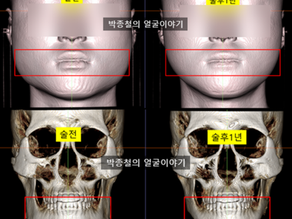 CT 분석을 활용한 사각턱 수술 1년 경과 관찰: 교근 절제술 병행 증례