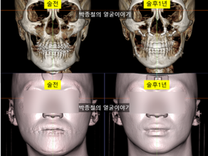 주걱턱 교정, 턱끝 축소술 없이도 가능할까? 양악수술 1년 후기를 통해 알아보세요