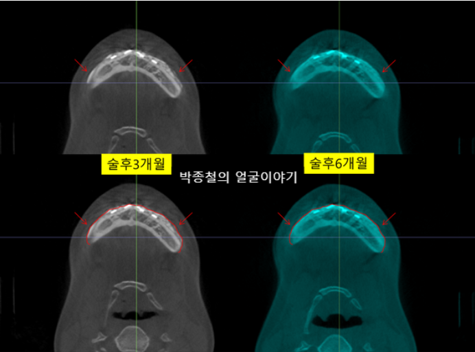 턱끝 전진술 자가골 이식 3개월 6개월 결과