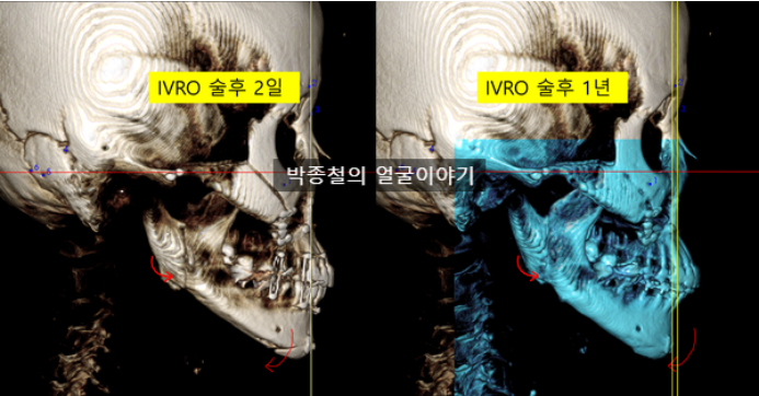 IVRO Condyle Sagging