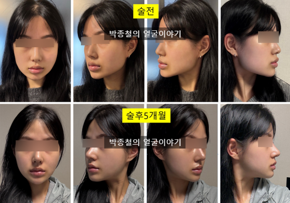 이미지 설명: 환자분께서 직접 촬영하신 수술 전과 수술 5개월 후 셀카 비교 사진입니다. 울퉁불퉁했던 턱선이 매끄럽게 정리되고 비대칭이 개선되어 만족스러운 결과를 보여줍니다.