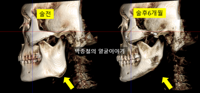 사각턱 축소술 6개월 경과