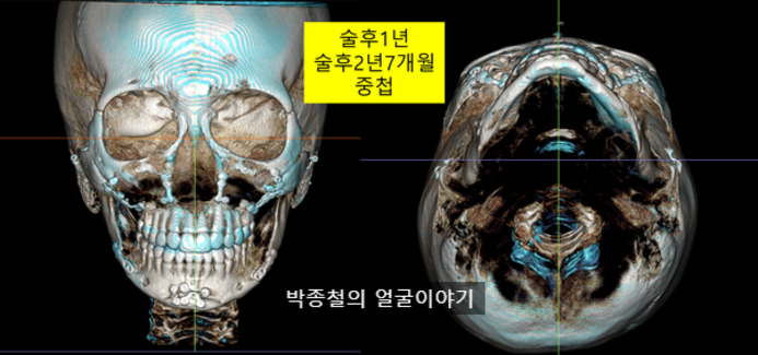 비대칭양악수술 후 장기적인 변화 (1년, 2년 7개월, 13년)