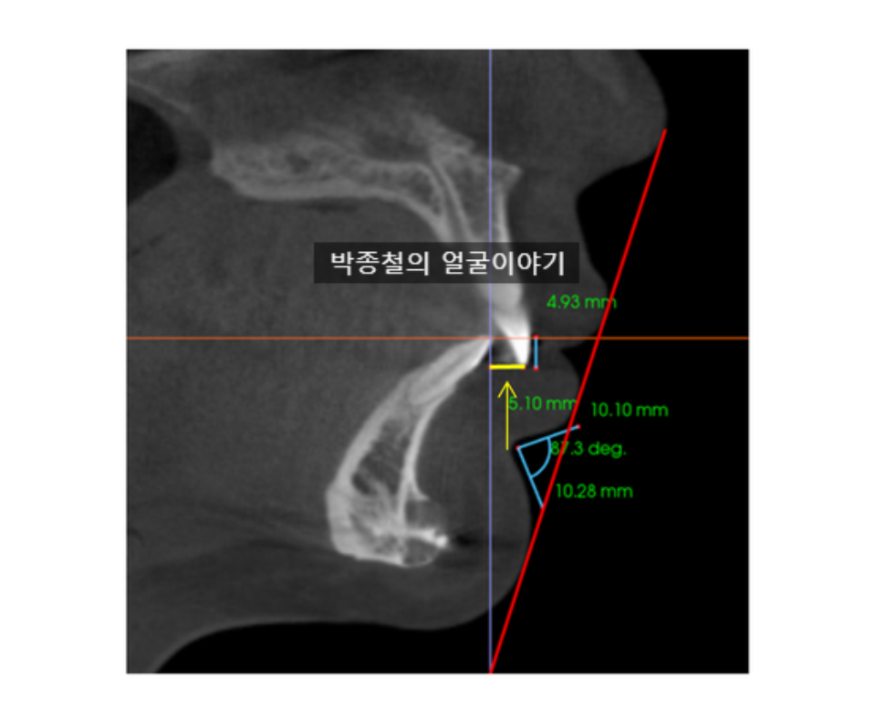 위 앞니의 끝 부분과 아래 앞니의 앞면 사이의 수평적 거리를 의미하는 수평피개교합(Overjet)의 개념을 명확하게 설명하는 그림입니다.
