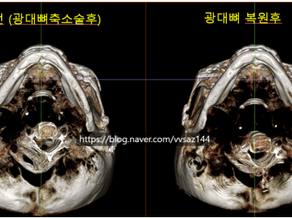 광대복원, 재수술 고민? 3D 이미지로 예측하고 자가골로 안전하게!