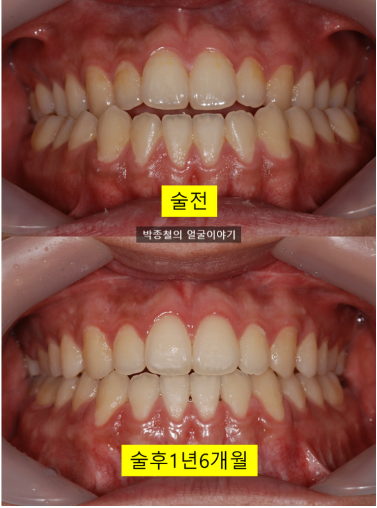 수술 전후 교합 이미지