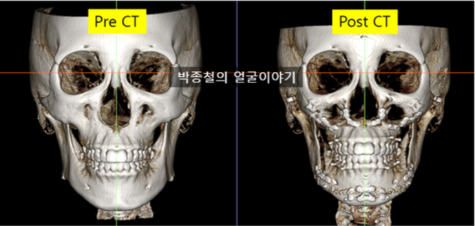 양악수술 CT