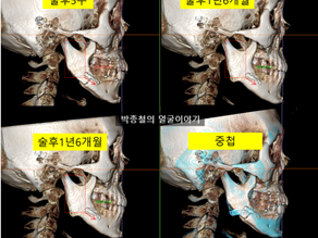 양악수술 후 뼈가 자랄 수 있을까요? - 20대 양악수술 환자의 잔여 성장 가능성에 대한 고찰