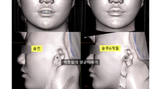 턱끝전진술후기 분석: 비대칭 무턱과 자가골이식의 중요성 (CT 데이터분석)