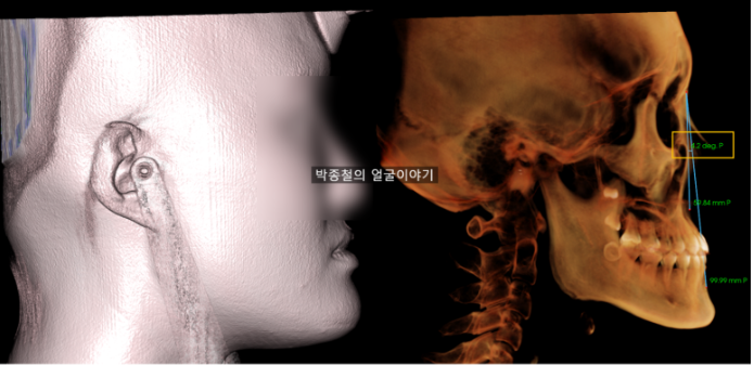 비수술주걱턱교정 후에도 아래턱이 전방에 위치한 모습