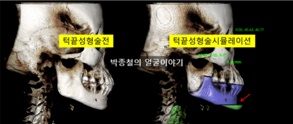 턱끝수술(턱끝성형술)이란, 보형물을 삽입하는 대신 아래턱뼈의 끝부분을 직접 절골하여 위치와 모양을 교정 후 재고정하는 수술 방식