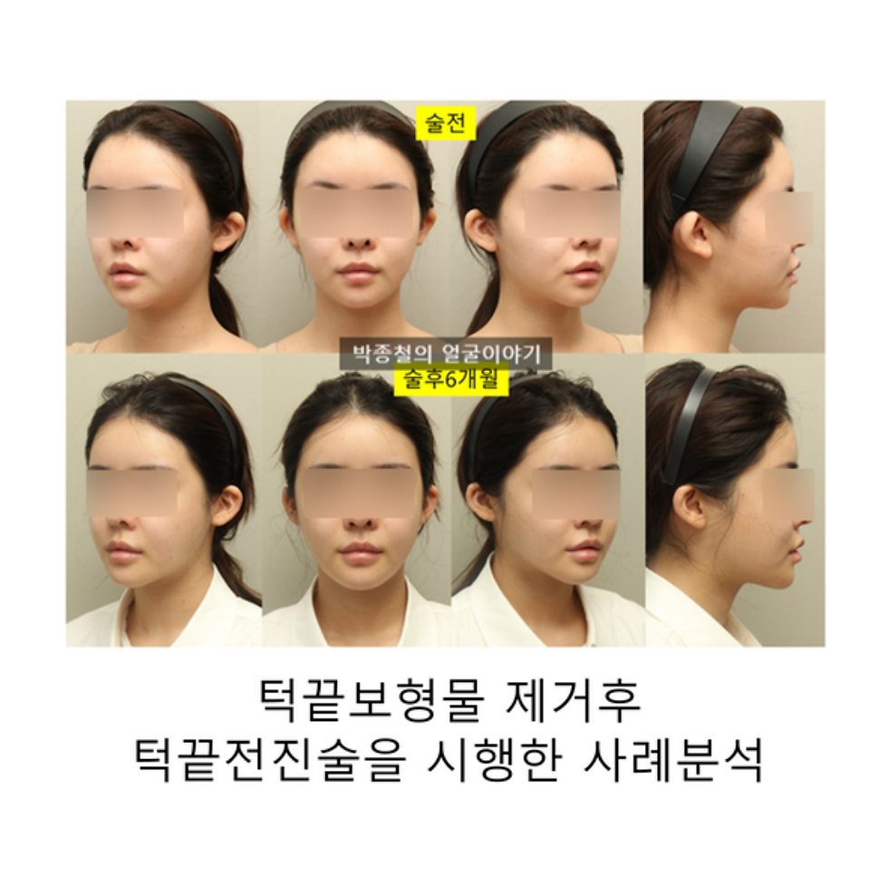 턱끝보형물 제거 후 턱끝전진술: 비대칭 교정과 자가골 생착 사례 분석