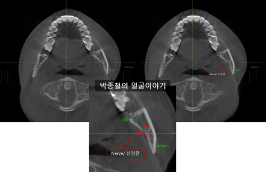 하지조신경관과 피질골간의 거리