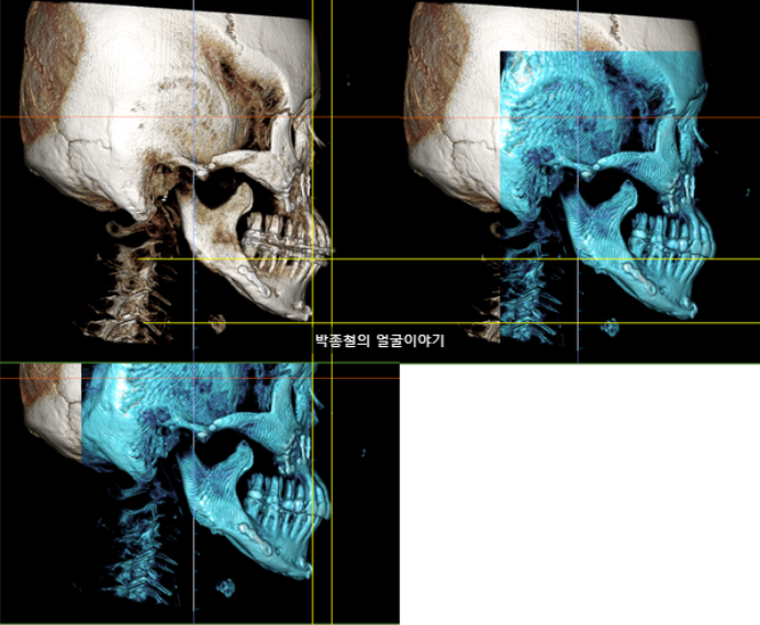 50세 양악수술 후 11년