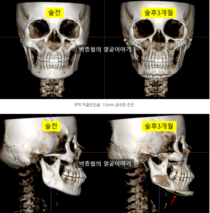수술 후 3개월 CT 분석: 10mm 금속판을 이용한 턱끝전진술 결과