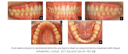 정상적인 교합관계