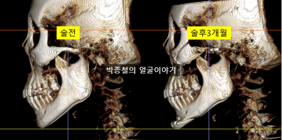 턱끝 수술 3개월 후 CT 측면이미지
