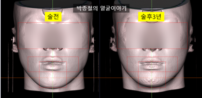 안면윤곽 수술 전후 3년 ct 이미지