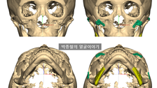 광대재수술 6개월 후기: 3D 광대재건을 통한 볼륨감 회복
