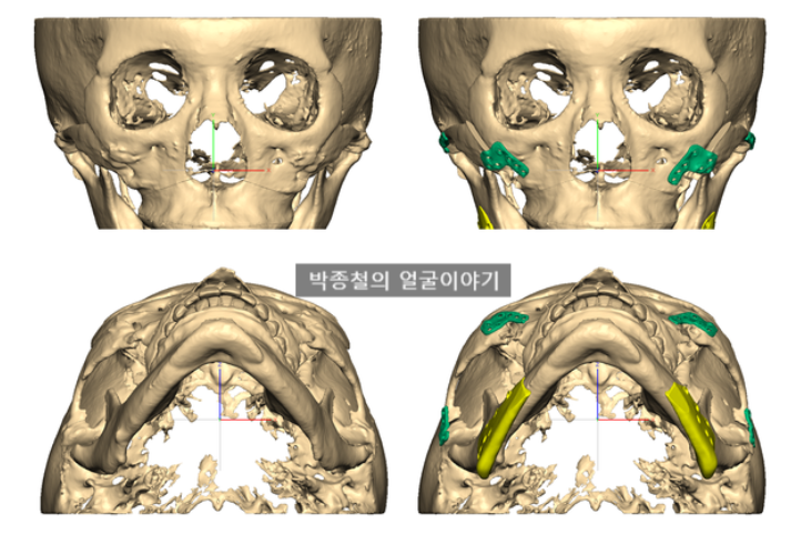 광대재수술 6개월 후기: 3D 광대재건을 통한 볼륨감 회복