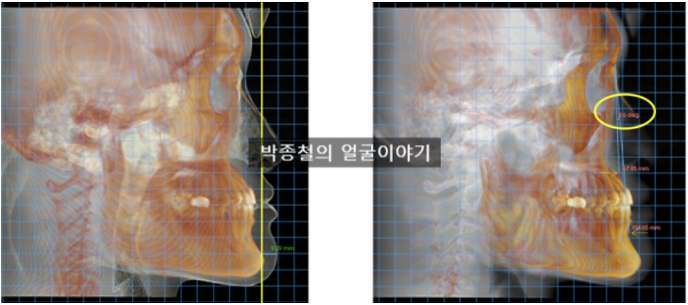비하점(subnasale)을 기준으로 9mm나 전방으로 돌출된 심한 골격성 주걱턱