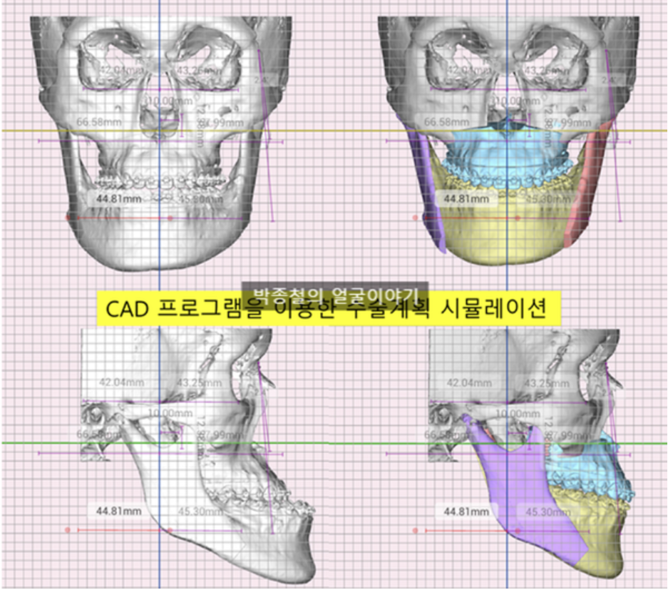 CAD프로그램을 이용한 디지털양악수술계획 시뮬레이션