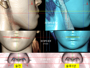 3D CT Analysis of Soft Tissue Changes After Orthognathic Surgery for Prognathism and Facial Asymmetry