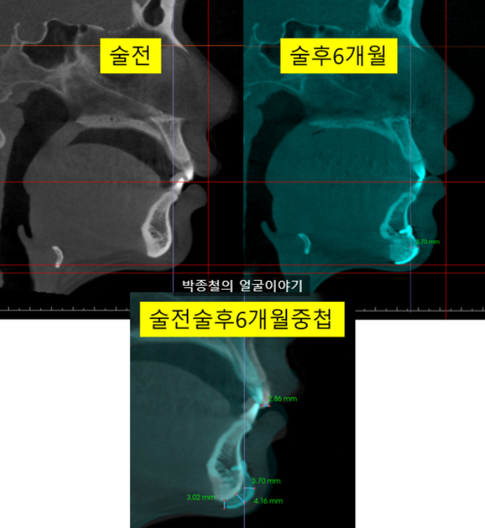 턱끝전진술 술후 ct비교