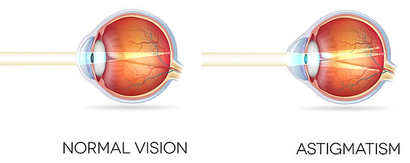 Astigmatism.jpg
