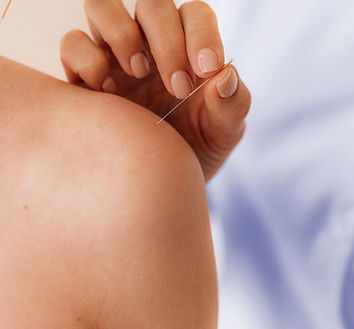 Shoulder Acupuncture_edited.jpg