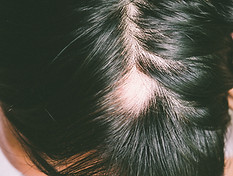 alopecia_areata_philip_kinglsey.jpg
