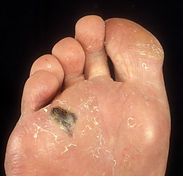 Acral-lentiginous-melanoma-on-the-planta