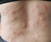 hives-symptoms-722x406.jpg