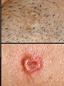 collage_of_basal_cell_carcinoma.jpg
