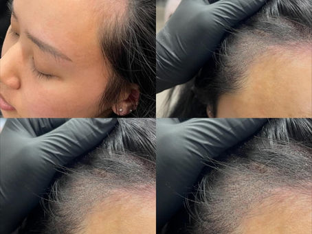 Hairline, density or scar camouflage: which SMP goal are you exploring?