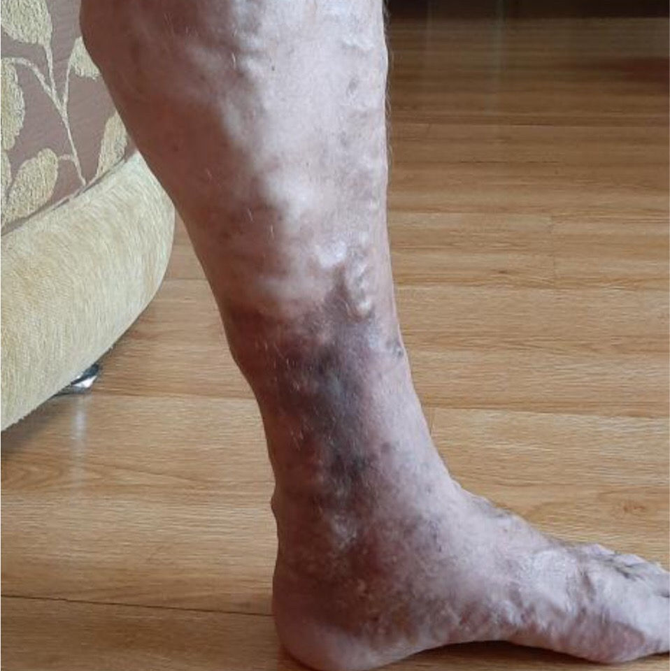 Как выглядит варикозное расширение вен на ногах фото