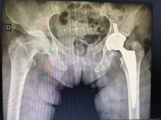 artroplastia do quadril