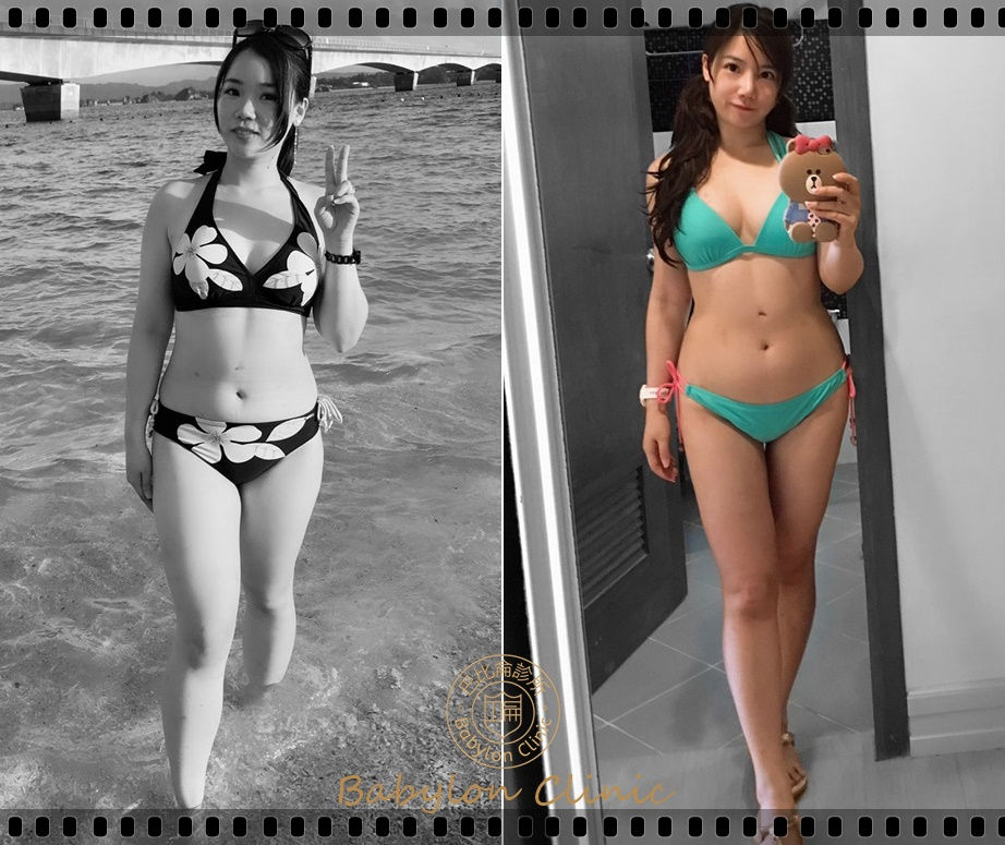 手臂及大腿威塑抽脂見證