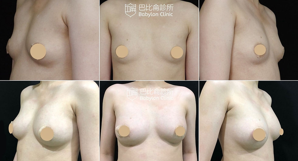 自體脂肪隆乳前後