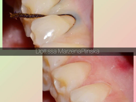 Recessione gengivale