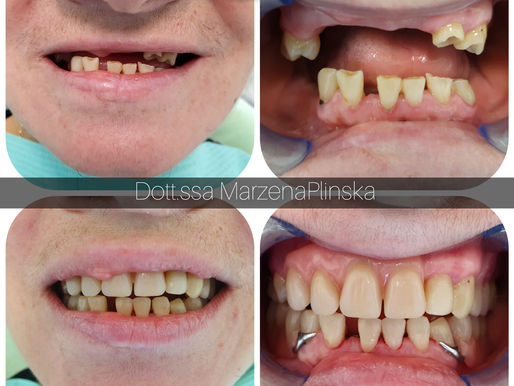 Riabilitazione senza chirurgia