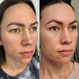 San Diego Fibroblast skin tightening plasmalift